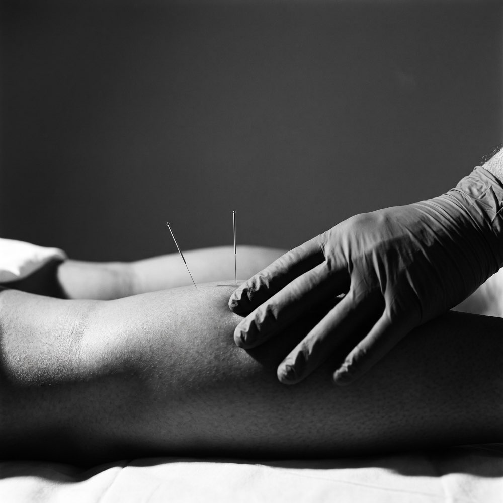Dry needling applied to a patient's calf muscle