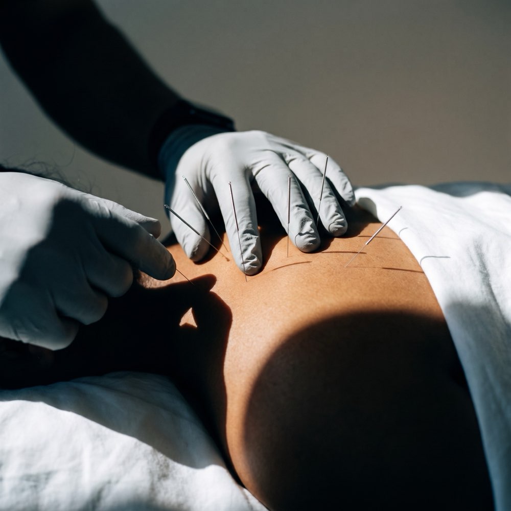 Dry needling applied to a patient's upper shoulder muscle